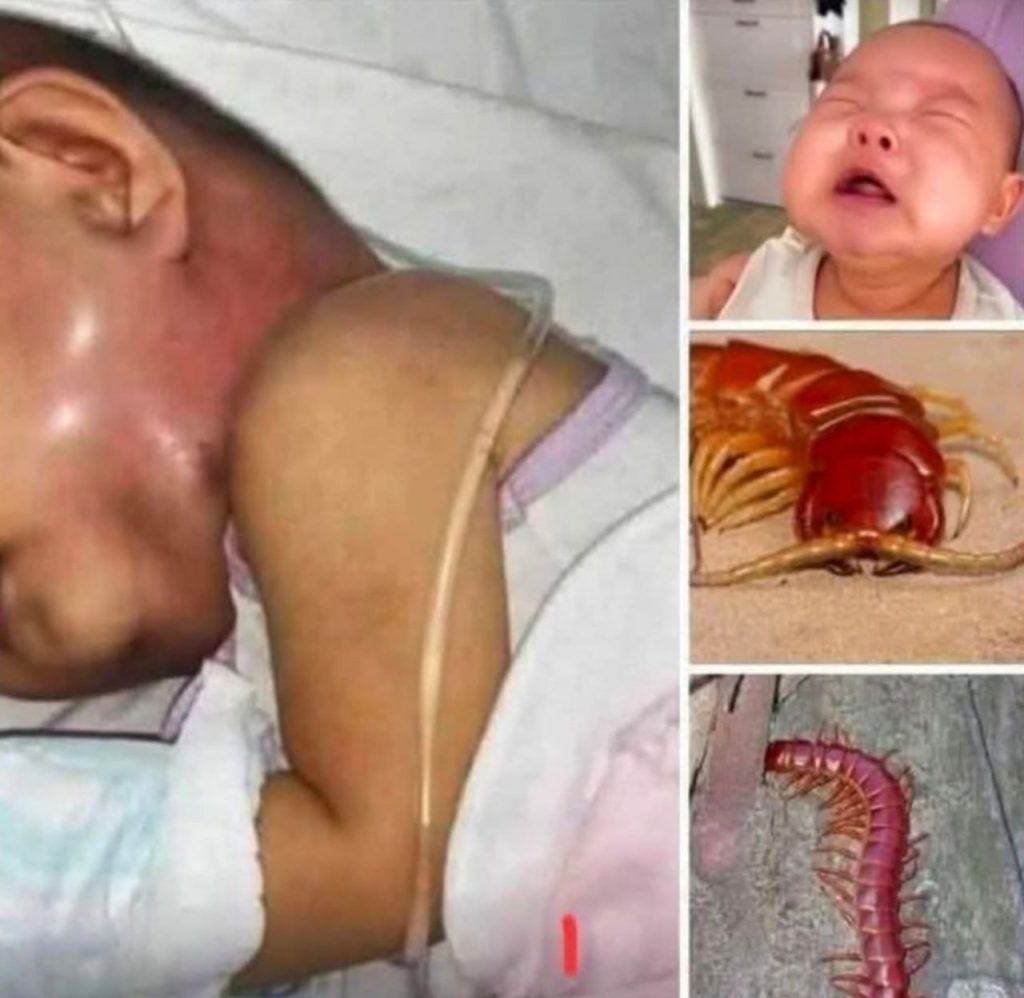 The Hidden Dangers of Centipede Bites in Infants: A Wake-Up Call for Parents