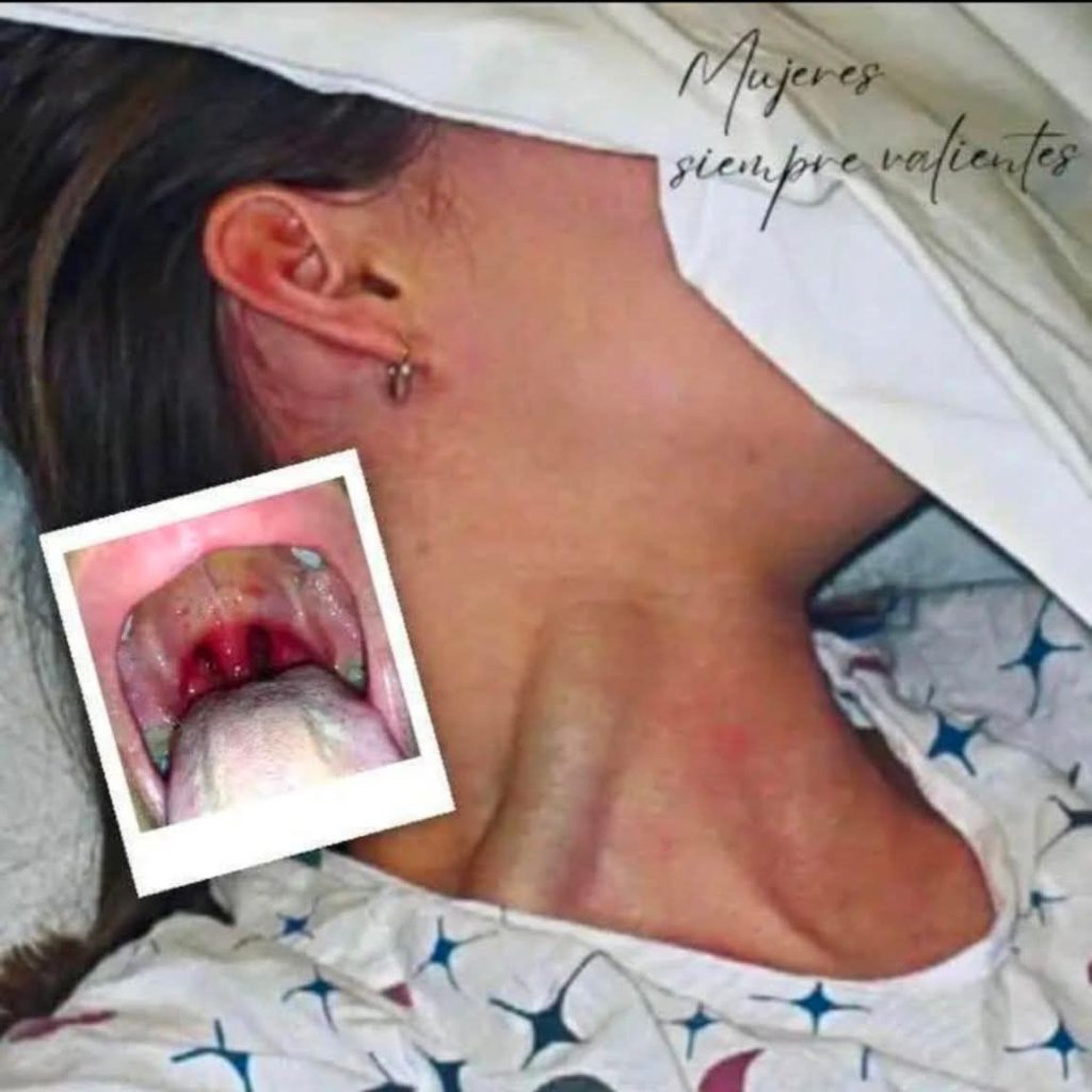 🩺 What Her Throat Reveals: A Look at Severe Throat Inflammation